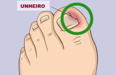 Métodos naturais para curar os unheiros