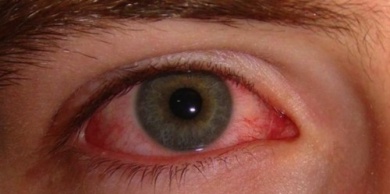 Causas e remédios para os olhos vermelhos