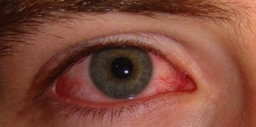 Olhos vermelhos podem indicar ansiedade