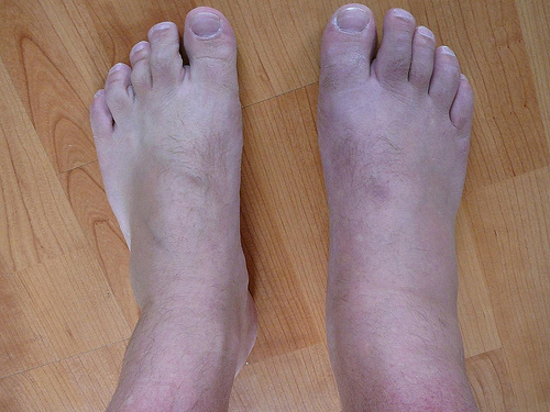 Bicarbonato de sódio para a gota