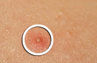 Tratamento com chá verde para tratar a acne