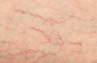 Remédios para as veias de aranha nas pernas