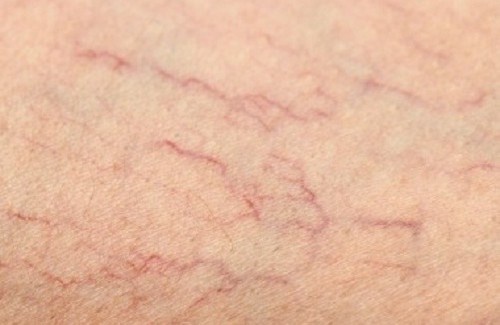 Remédios para as veias de aranha nas pernas