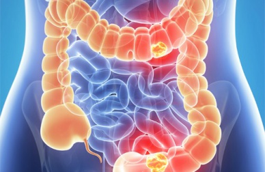 Hábitos que prejudicam os intestinos