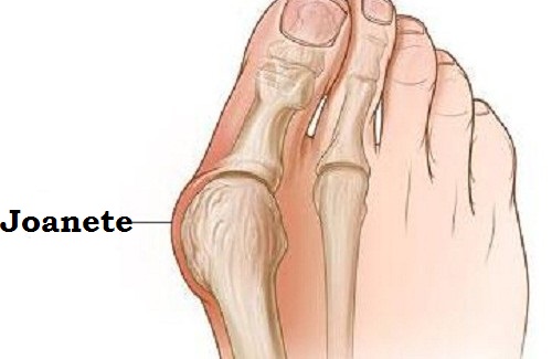 Como prevenir os joanetes? Como prevenir os joanetes?
