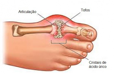Sintomas e tratamentos para a gota
