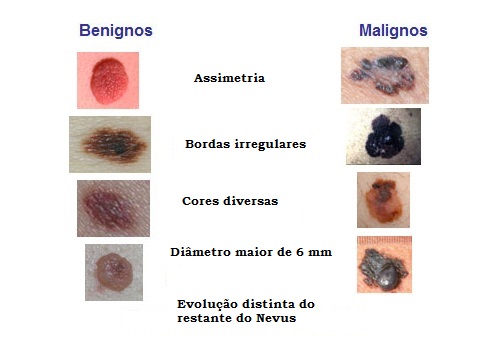 Melanomas