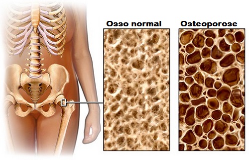 Dieta para evitar a osteoporose
