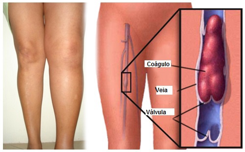 O que é uma trombose e como preveni-la?
