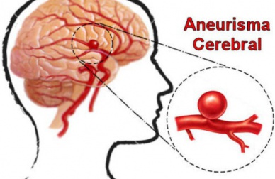 O que são e como prevenir os aneurismas cerebrais?