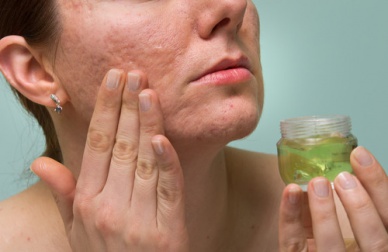 Como reduzir as marcas de acne com remédios naturais