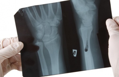 Alimentos que prejudicam a saúde dos ossos