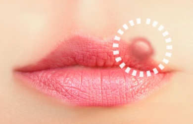 10 tratamentos naturais contra o herpes labial