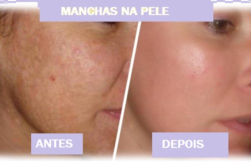 Água oxigenada pode eliminar manchas na pele.