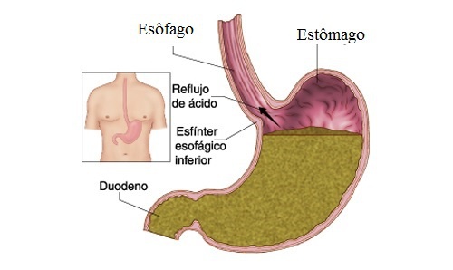 Como curar o refluxo gástrico?