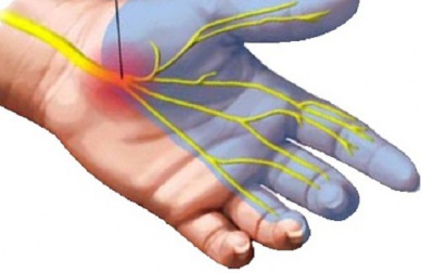 Síndrome do túnel do carpo: remédios naturais para aliviar os sintomas
