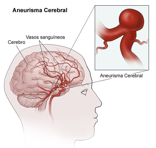 aneurismas