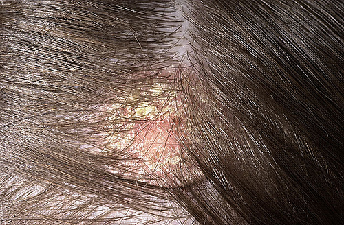 Couro cabelo precisando de tratamento para a dermatite seborreica