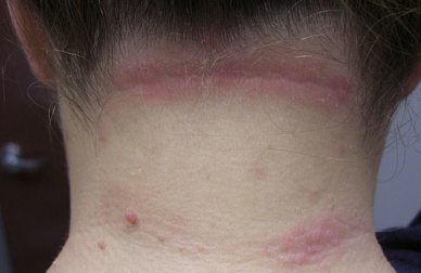 Tratamento eficaz para a dermatite seborreica