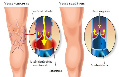 O creme para varizes ativa a circulação