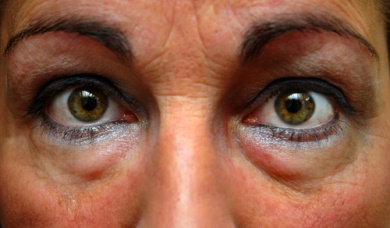 Como tratar as bolsas nos olhos?