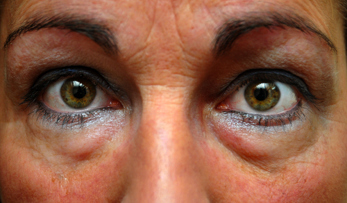 Bolsas nos olhos