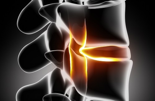 uma hérnia de disco