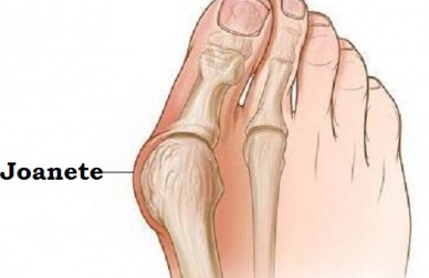 Por que os joanetes são formados?