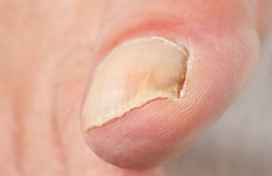 Tratamento para as principais doenças nas unhas