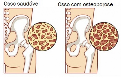 Como controlar a osteoporose durante a menopausa