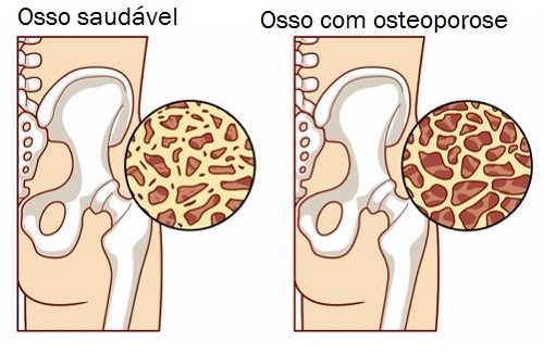 Como controlar a osteoporose durante a menopausa