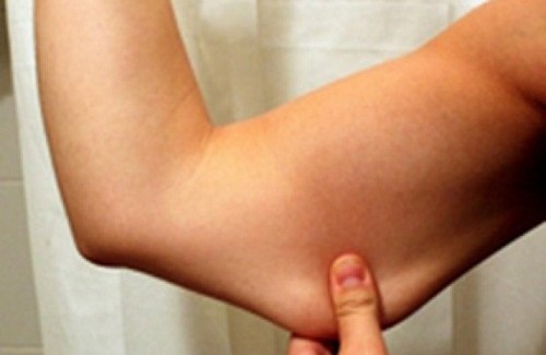 Como combater a flacidez nas pernas e braços? Como combater a flacidez nas pernas e braços?