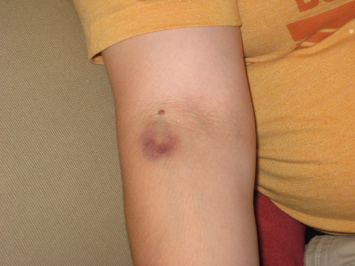 Hematomas no corpo como tratar