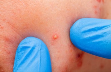 Espinhas e cravos: por que aparecem e como preveni-los