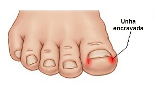 Principais doenças nas unhas