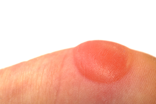 Sintomas do cobreiro