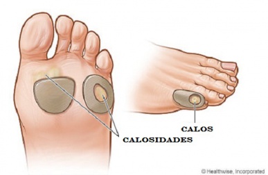 Como tratar naturalmente os calos e calosidades?