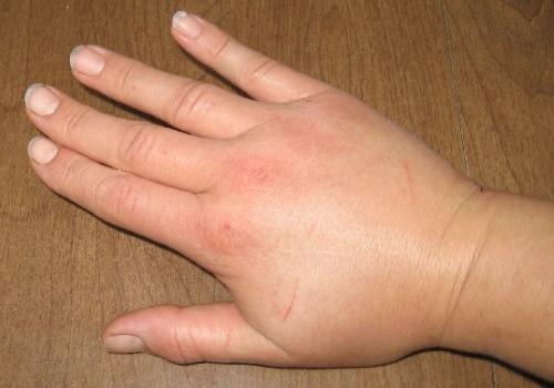 Como prevenir a retenção de líquidos naturalmente?