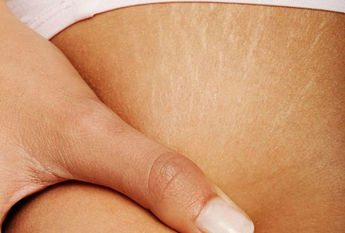 Estrias! Veja como tratá-las de forma natural.
