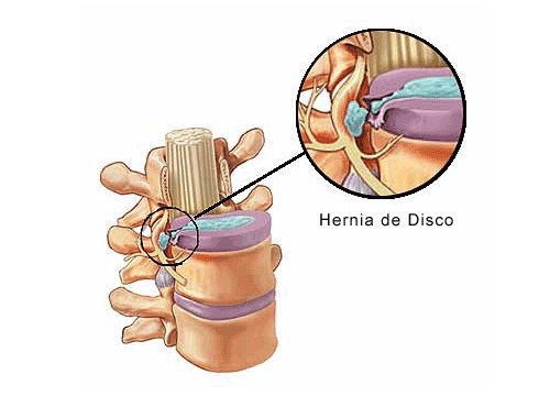 Sintomas de uma hérnia de disco