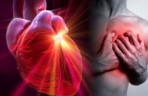 Como reconhecer as diferenças entre um infarto, uma parada cardíaca e um ataque cardíaco