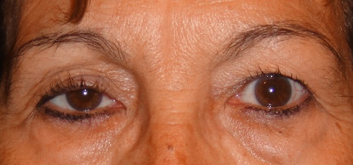 Mulher que tem problemas nos olhos