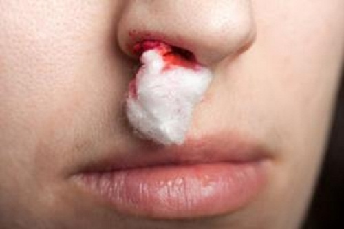 O que você pode fazer quando seu nariz sangrar?