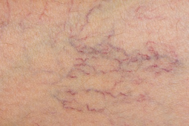 Tratamento natural para prevenir as varizes