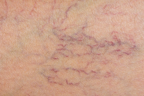 Tratamento natural para prevenir as varizes