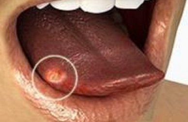 Língua branca: causas e soluções