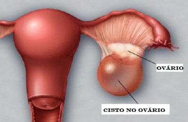 Como detectar os cistos nos ovários?