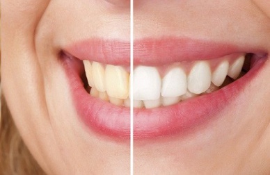 Dicas naturais para cuidar mais dos dentes