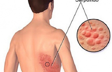 Como tratar o “cobreiro” naturalmente?