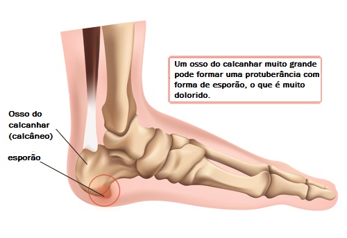 Dor no calcanhar? Por que isso ocorre? - Melhor Com Saúde